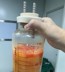 淮南水动力吸脂手术要做多久？